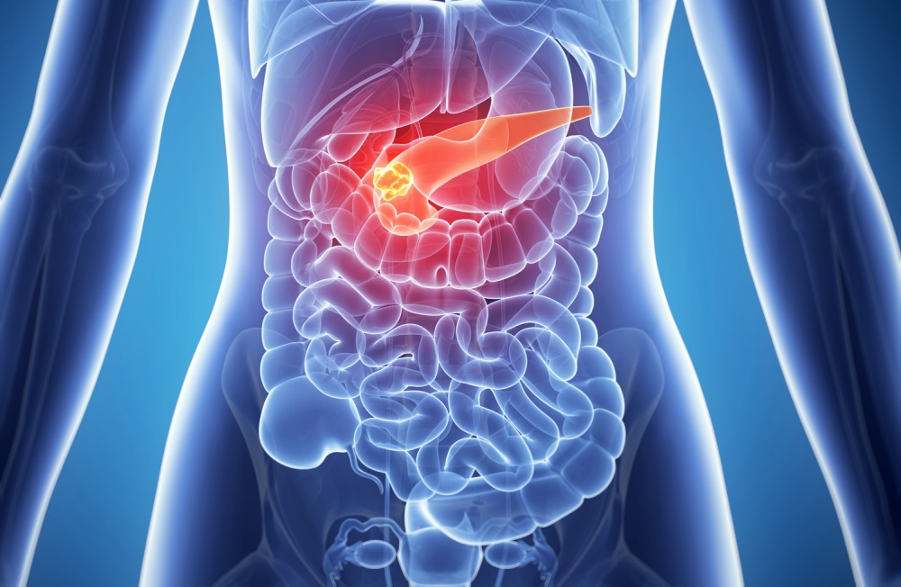 Metastatic pancreatic cancer: a new clinical practice guideline - The ...